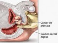 Curso de Cancer de Prostata
